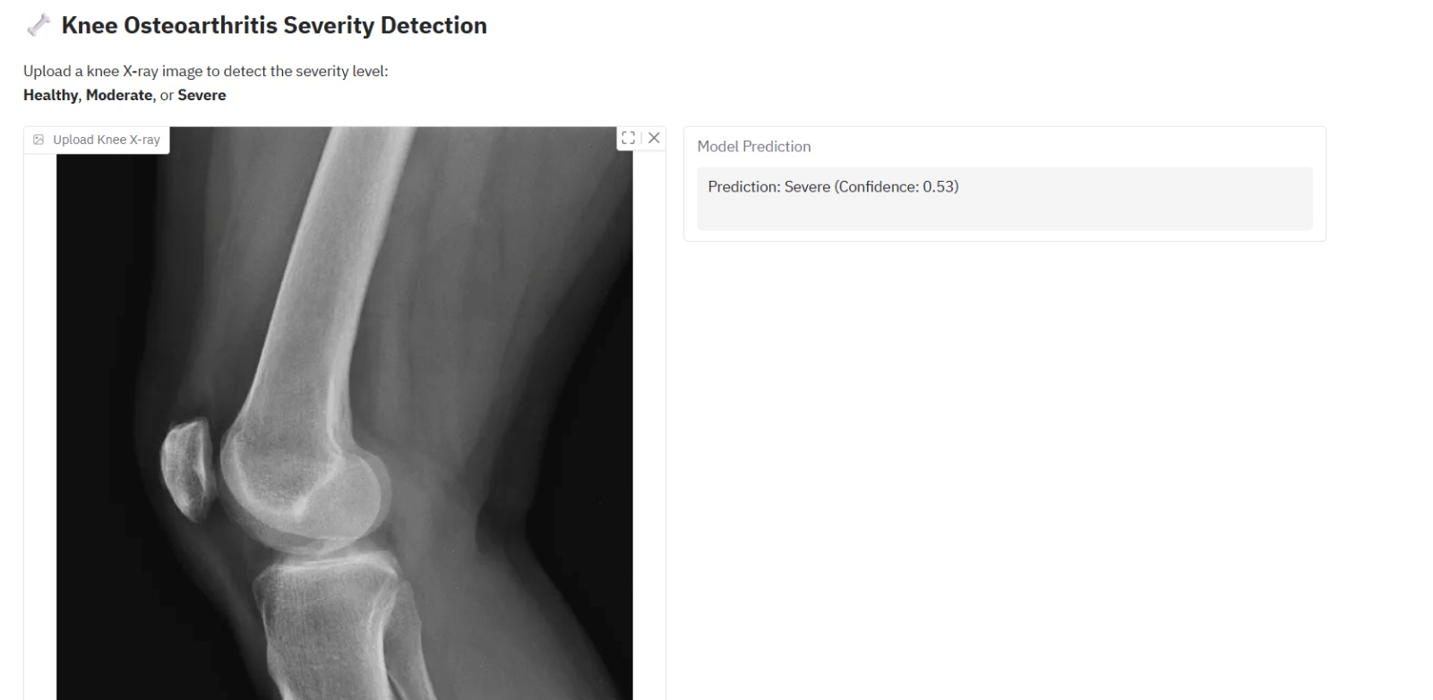Deep learning based knee osteoarthritis severity detection interface